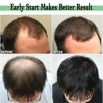 Titano Barzda & Plaukai Atauga Microneedling už kovą su Plaukų Slinkimas Gydymo, Retinimo Plaukų, Odos Volelis